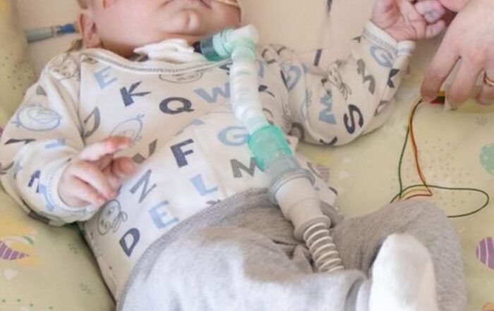 Luka - 29.4.2018 - Kogenitalna diafragmalna hernija